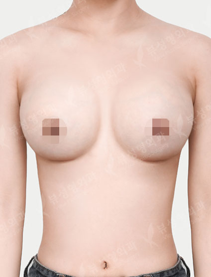 Breast Augmentation (Sebbin) (4 Months) — After