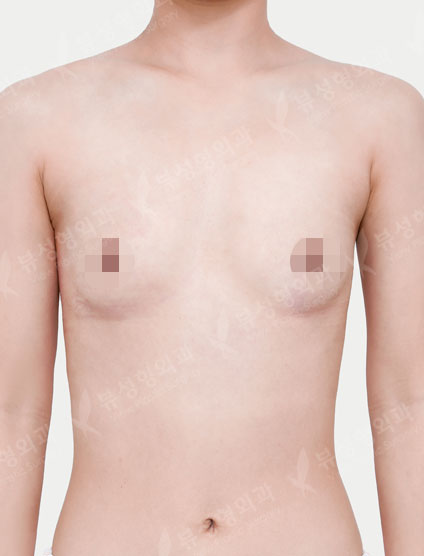 Breast Augmentation (Sebbin) (4Months) — Before
