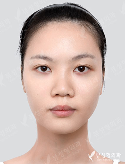 3 Types Facial Contouring + Revision Rhinoplasty — Before