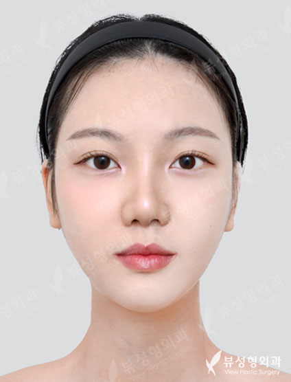 3 Types Facial Contouring + Revision Rhinoplasty — After