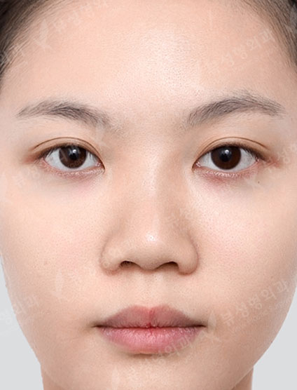 3 Types Facial Contouring + Revision Rhinoplasty — Before