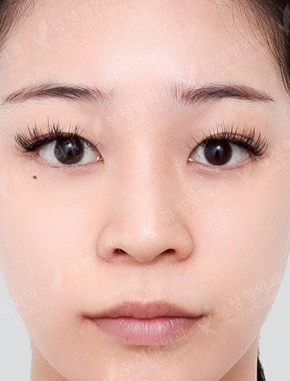 Rhinoplasty (7 Months) — Before