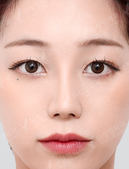 Rhinoplasty (7 Months) — After