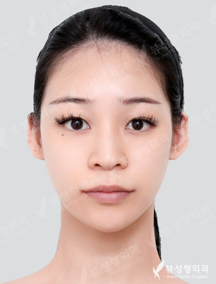 Rhinoplasty (7 Months) — Before