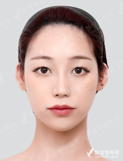 Rhinoplasty (7 Months) — After