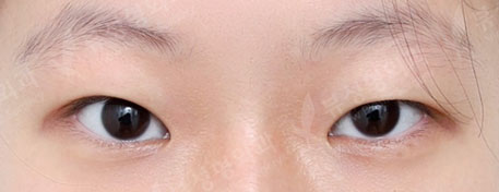 ศัลยกรรมตา + เปิดหัวตา + เปิดหางตา + เปิดใต้ตา (3 Months) — Before