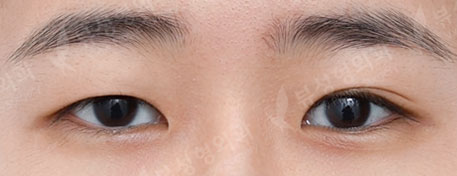 ศัลยกรรมตา + เปิดหัวตา (3 Months) — Before