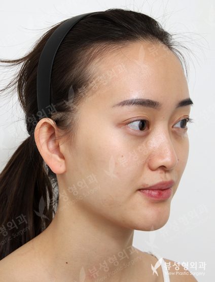Facial Contouring Before