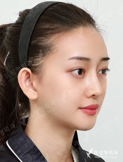 Facial Contouring After