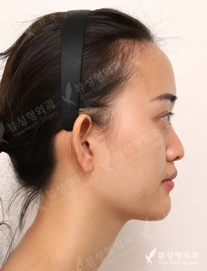 Facial Contouring Before