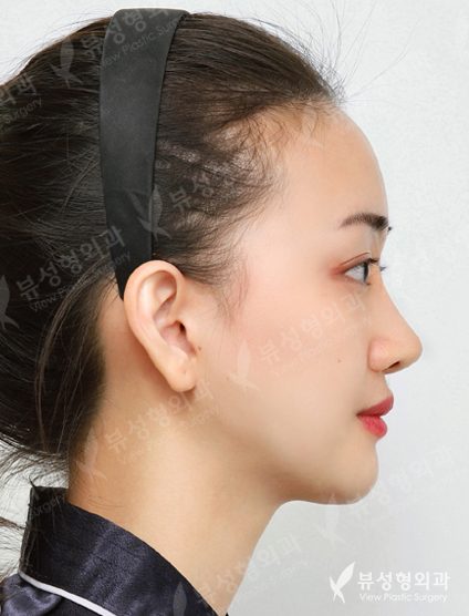 Facial Contouring After