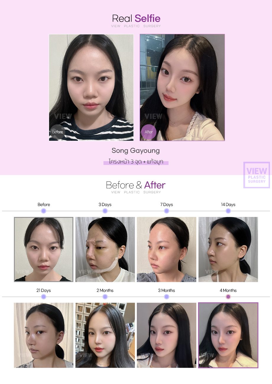 Revision Rhinoplasty + 3 Types Facial Contouring