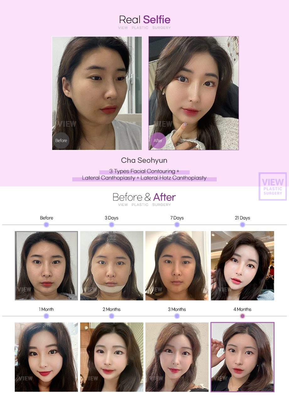 3 Types Facial Contouring + Lateral Canthoplasty + Lateral Hotz Canthoplasty
