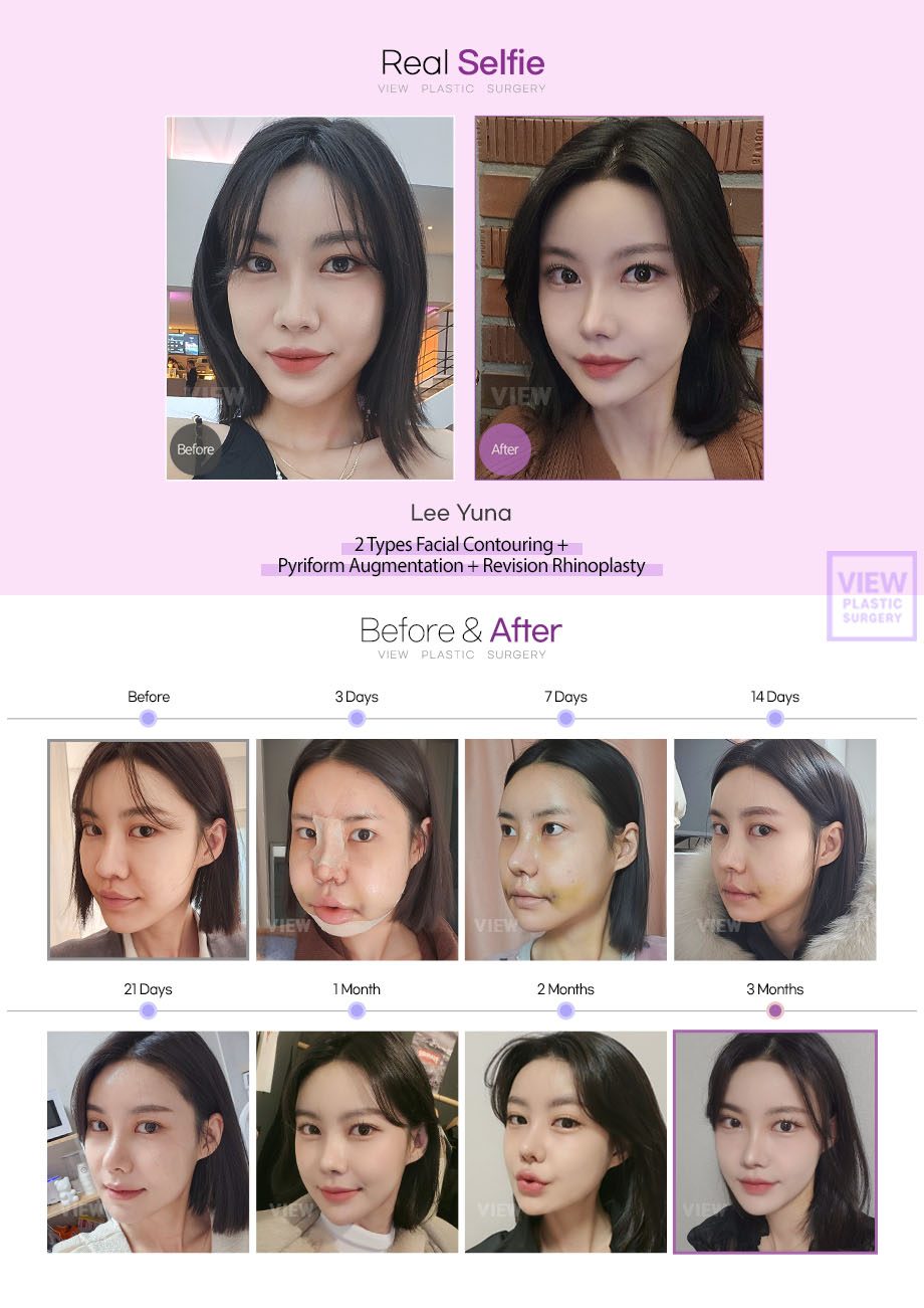 2 Types Facial Contouring + Pyriform Augmentation + Revision Rhinoplasty
