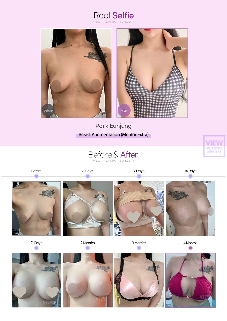 Breast Augmentation (Mentor Extra)