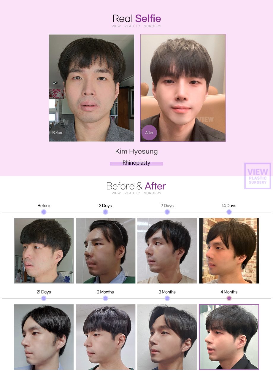 Rhinoplasty