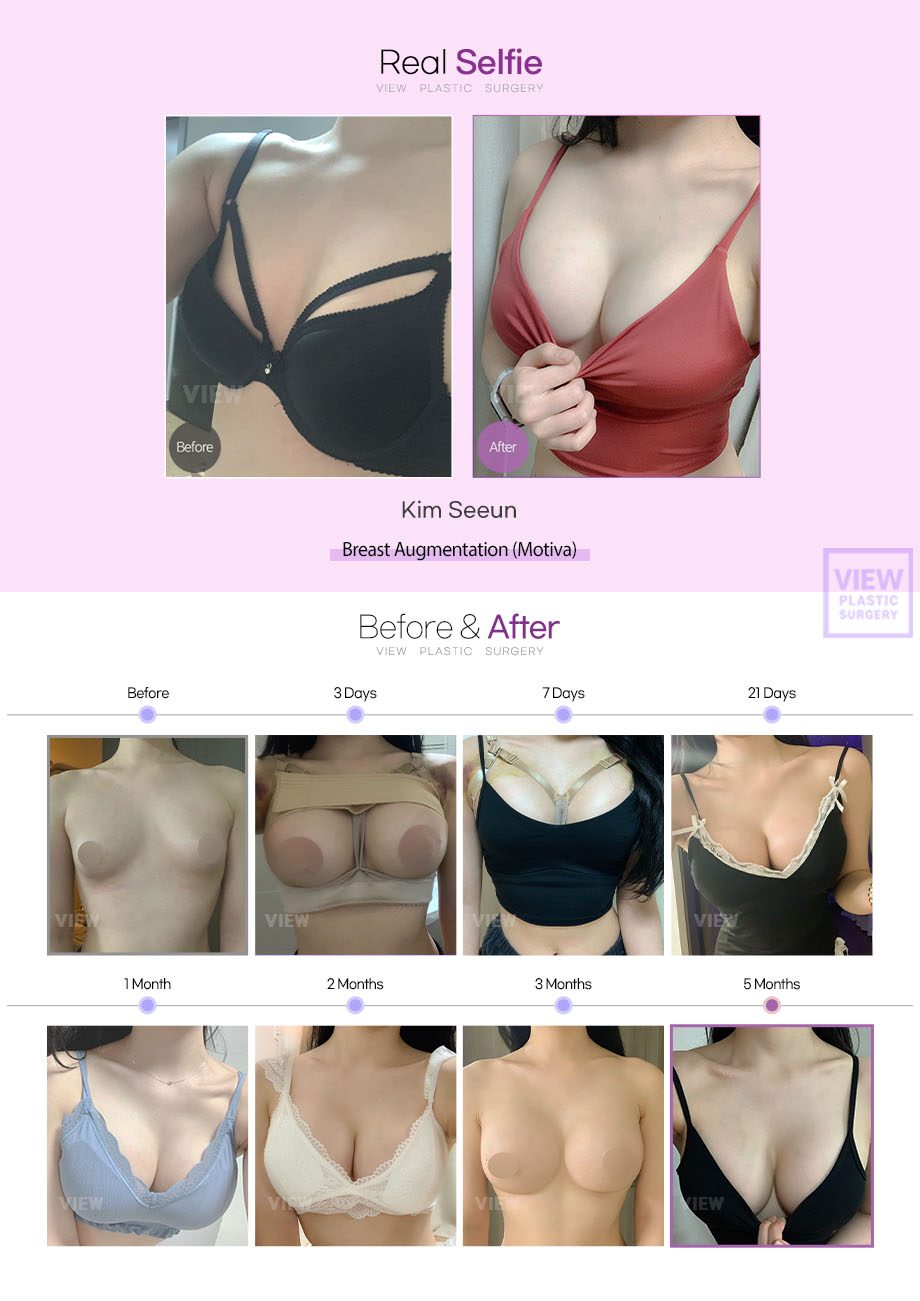 Breast Augmentation (Motiva)