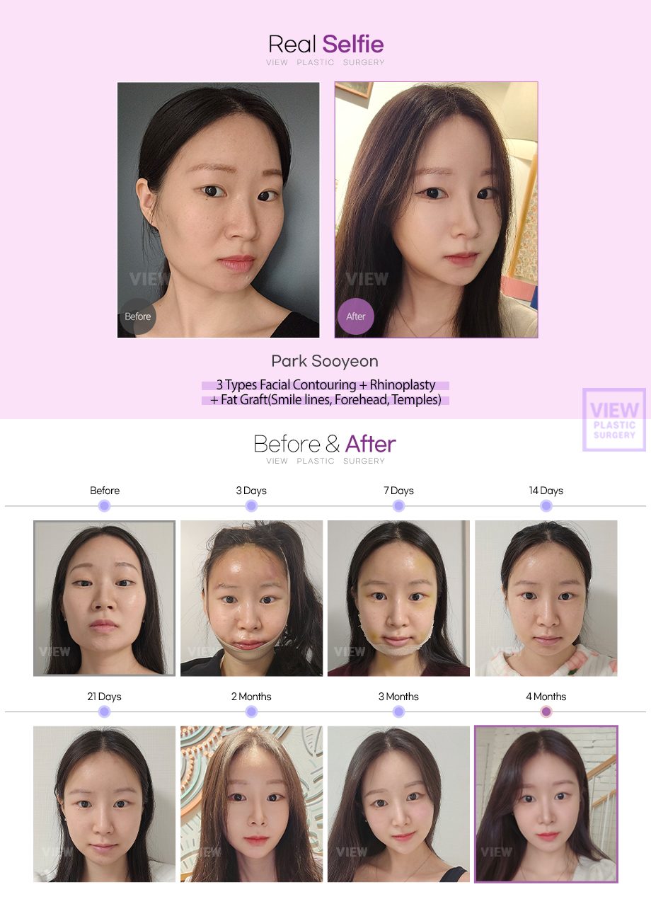 3 Types Facial Contouring + Rhinoplasty + Fat Graft(Smile lines, Forehead, Temples)