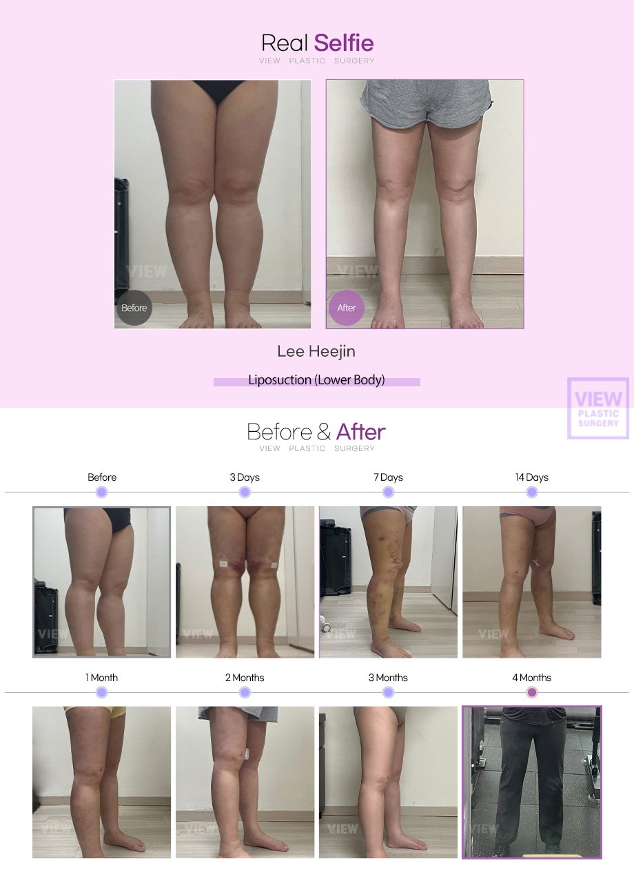 Liposuction (Lower Body)