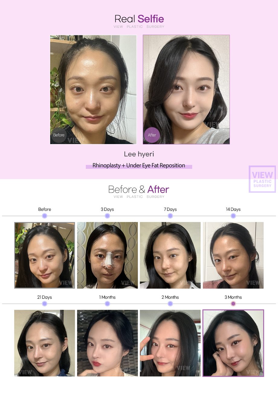 Rhinoplasty + Under Eye Fat Reposition