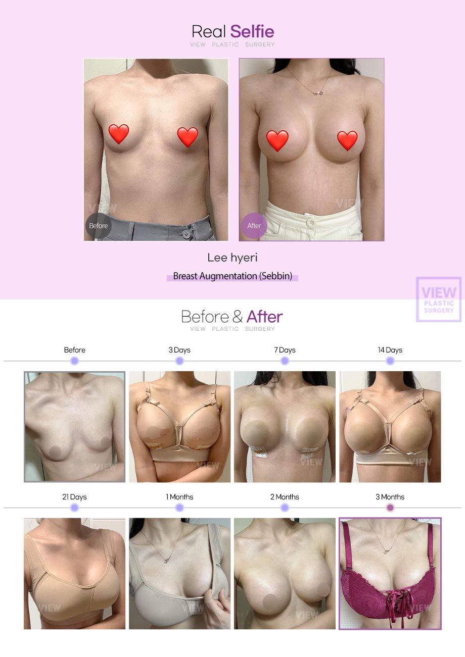 Breast augmentation (Sebbin)