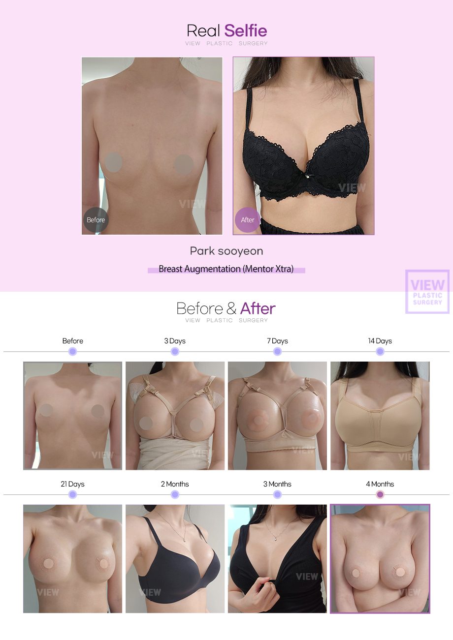 [Breast Augmentation (Mentor Xtra)]