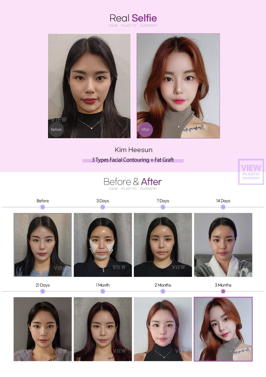 [3 Types Facial Contouring+Fat Graft]