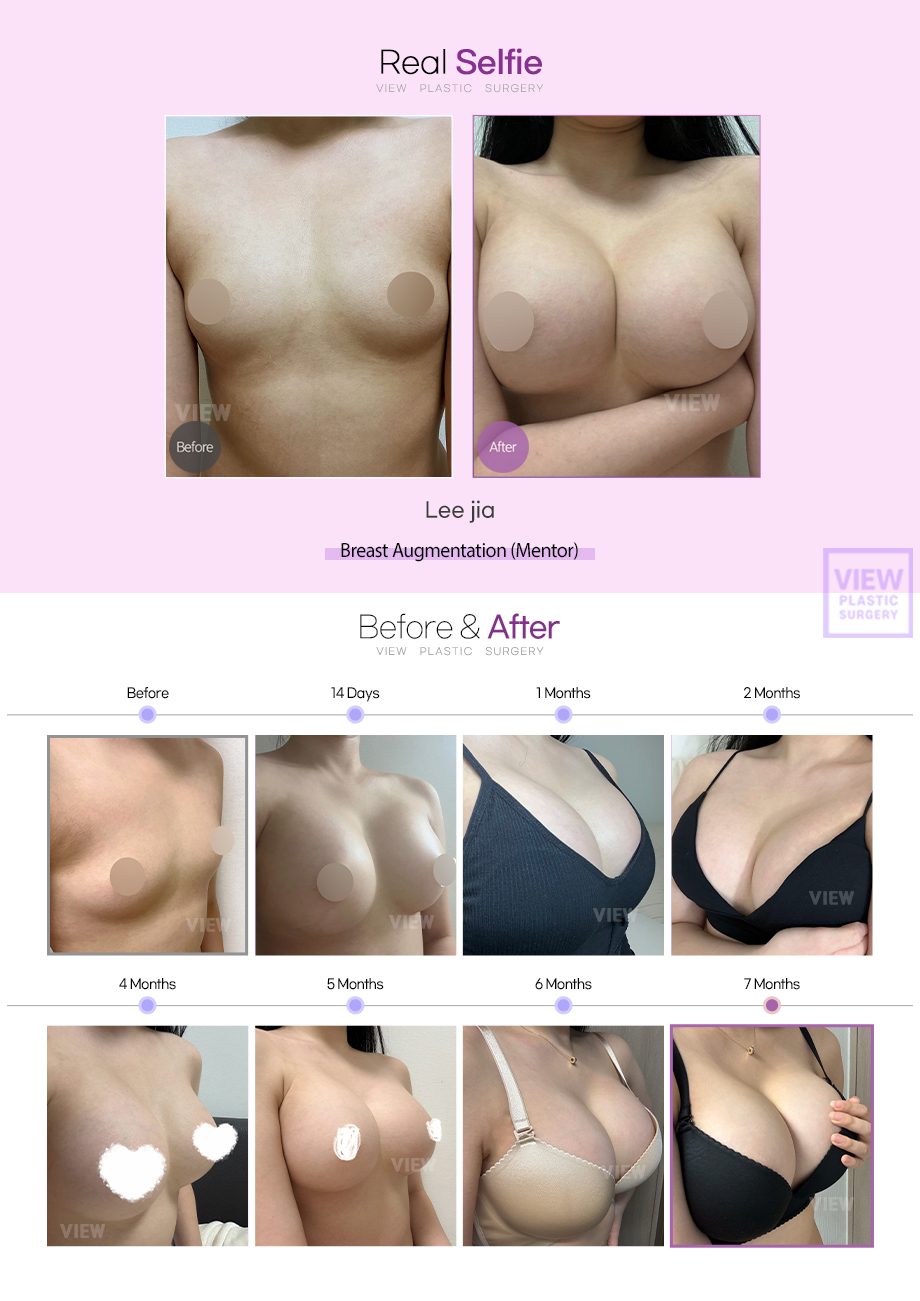 [Breast Augmentation(Mentor)]