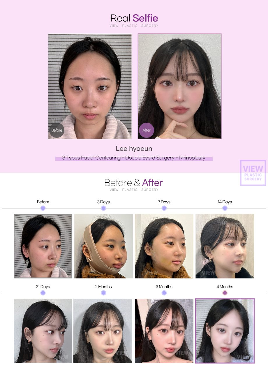 [3 Types Facial Contouring+Double Eyeild Surgery+Rhinoplasty]