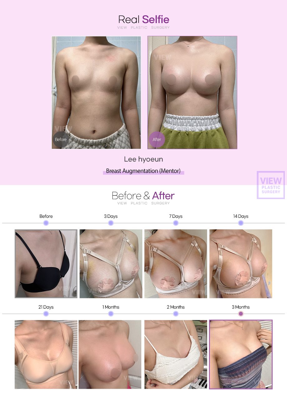 [Breast Augmentation(Mentor)]