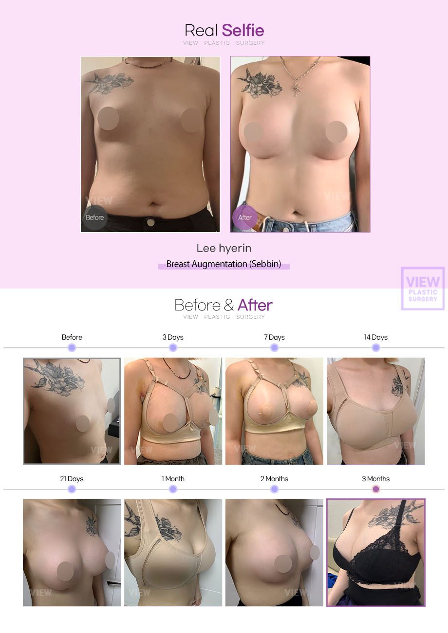 [Breast Augmentation (Sebbin)]