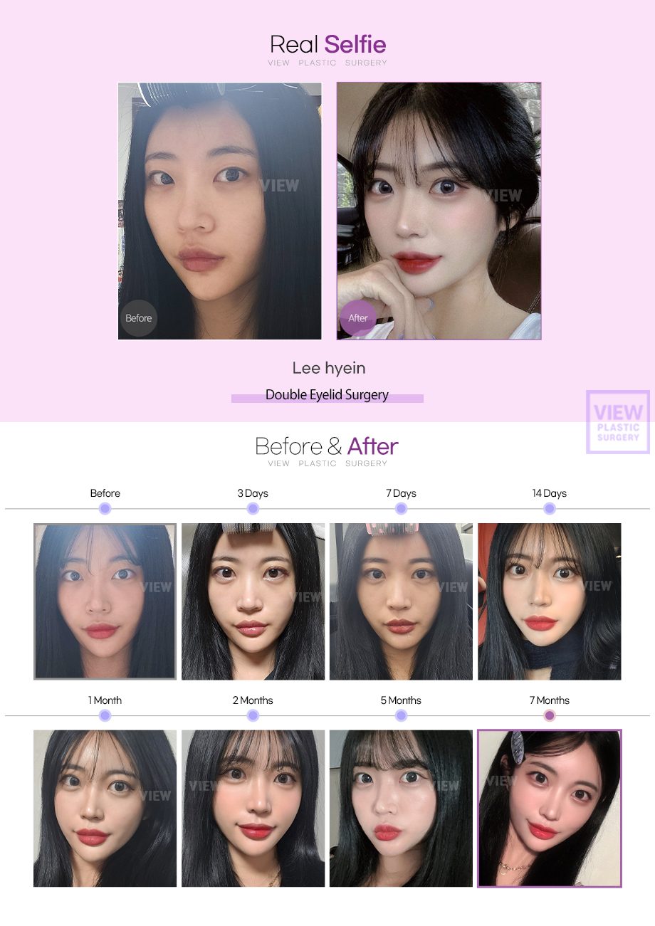 Double Eyelid Surgery, ptosis correction Double, Eyelid Revision Surgery, Revisional Epicanthoplasty