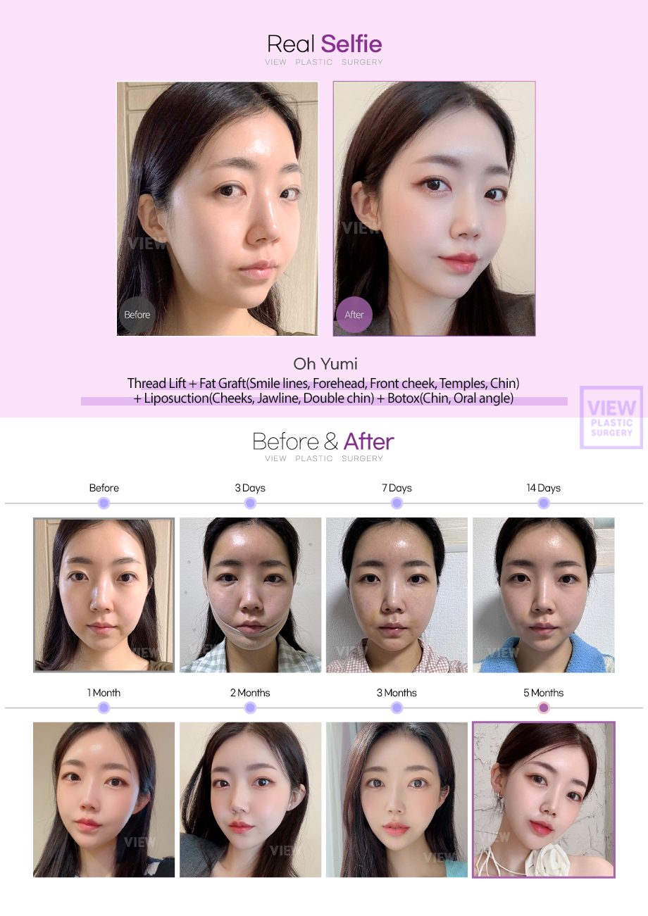Thread Lift + Fat Graft + Liposuction + Botox
