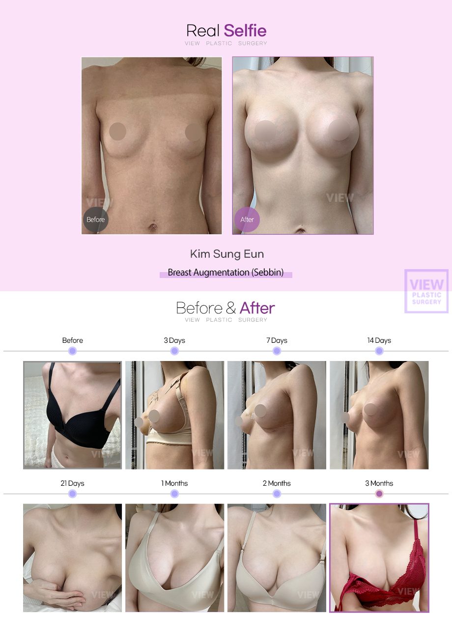 Breast Augmentation Review