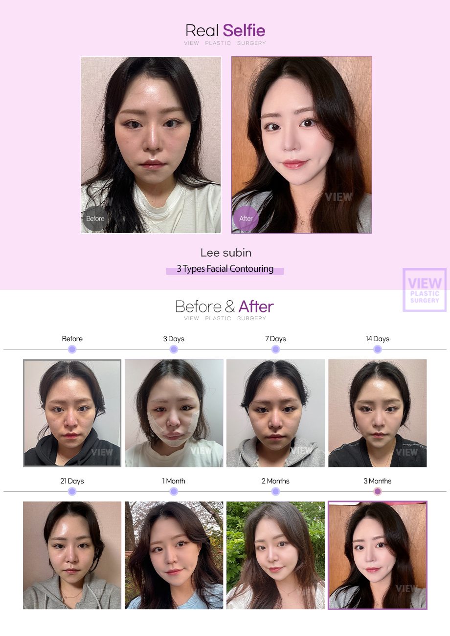 3 Types Facial Contouring