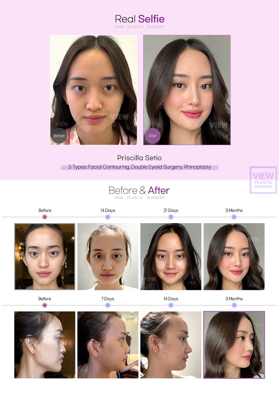 3 Types Facial Contouring, Double Eyelid Surgery, Rhinoplasty