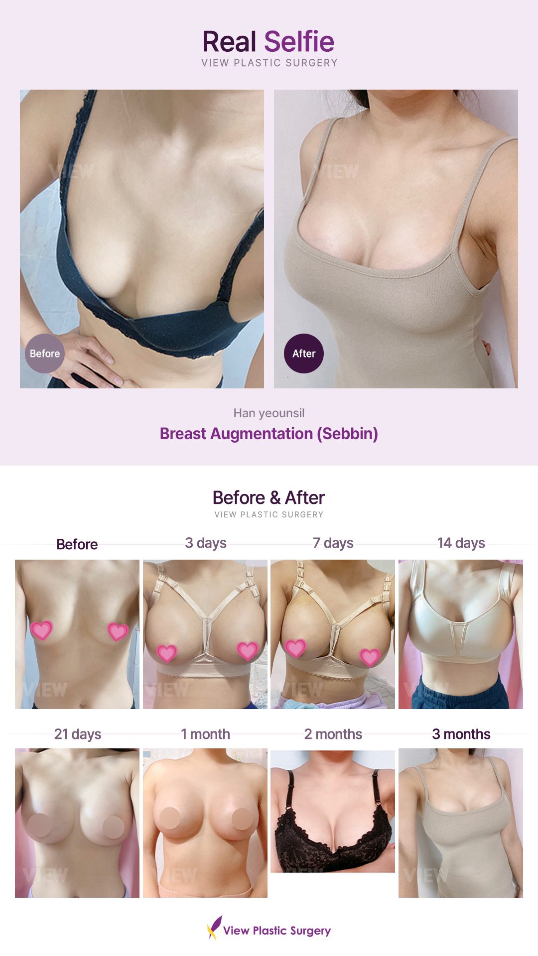 Breast Augmentation (Sebbin)
