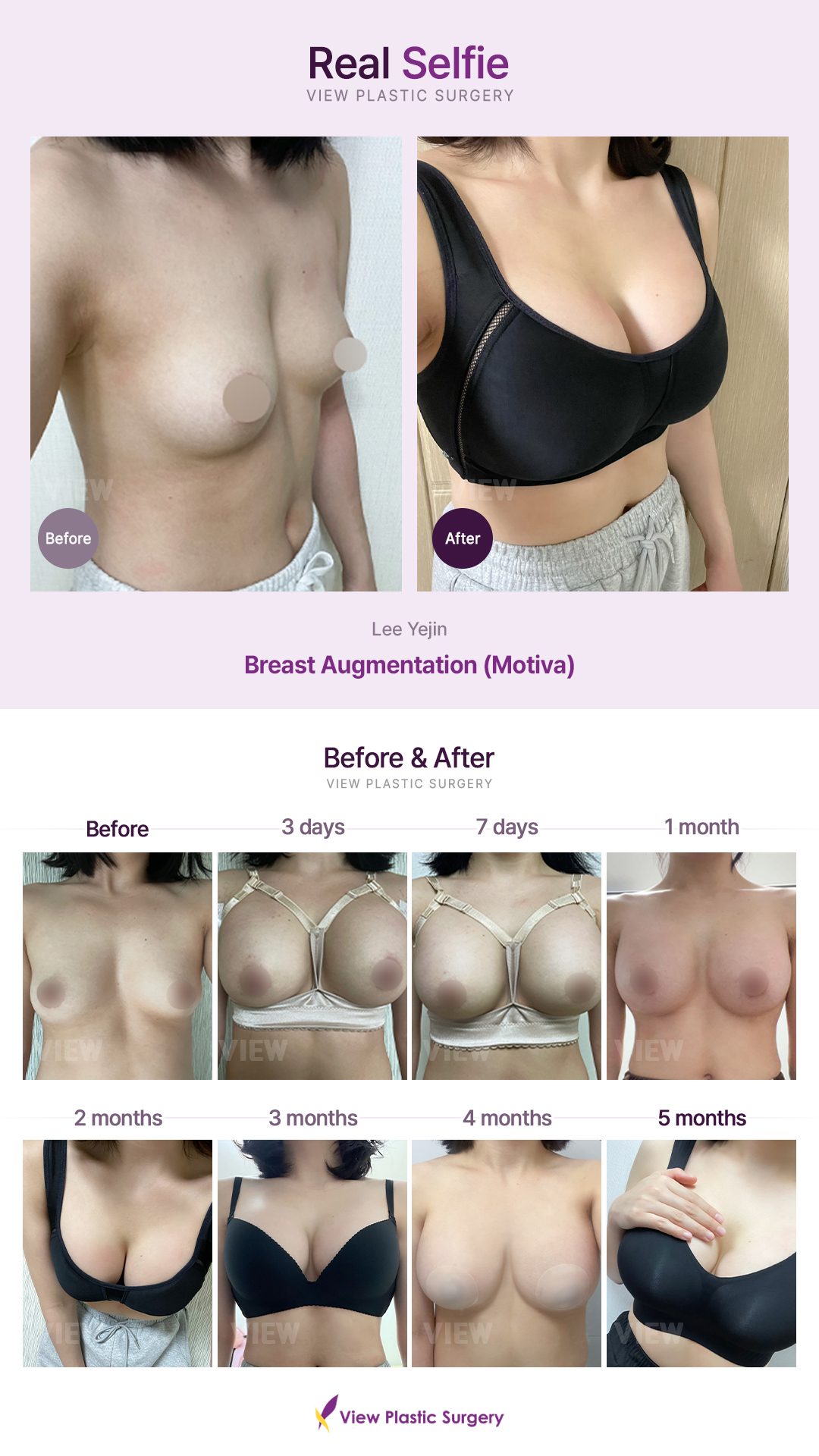 Breast Augmentation (Motiva)