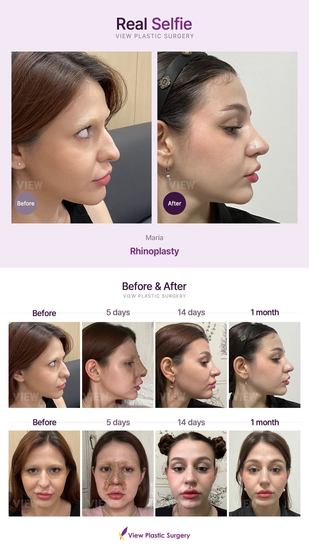 Rhinoplasty