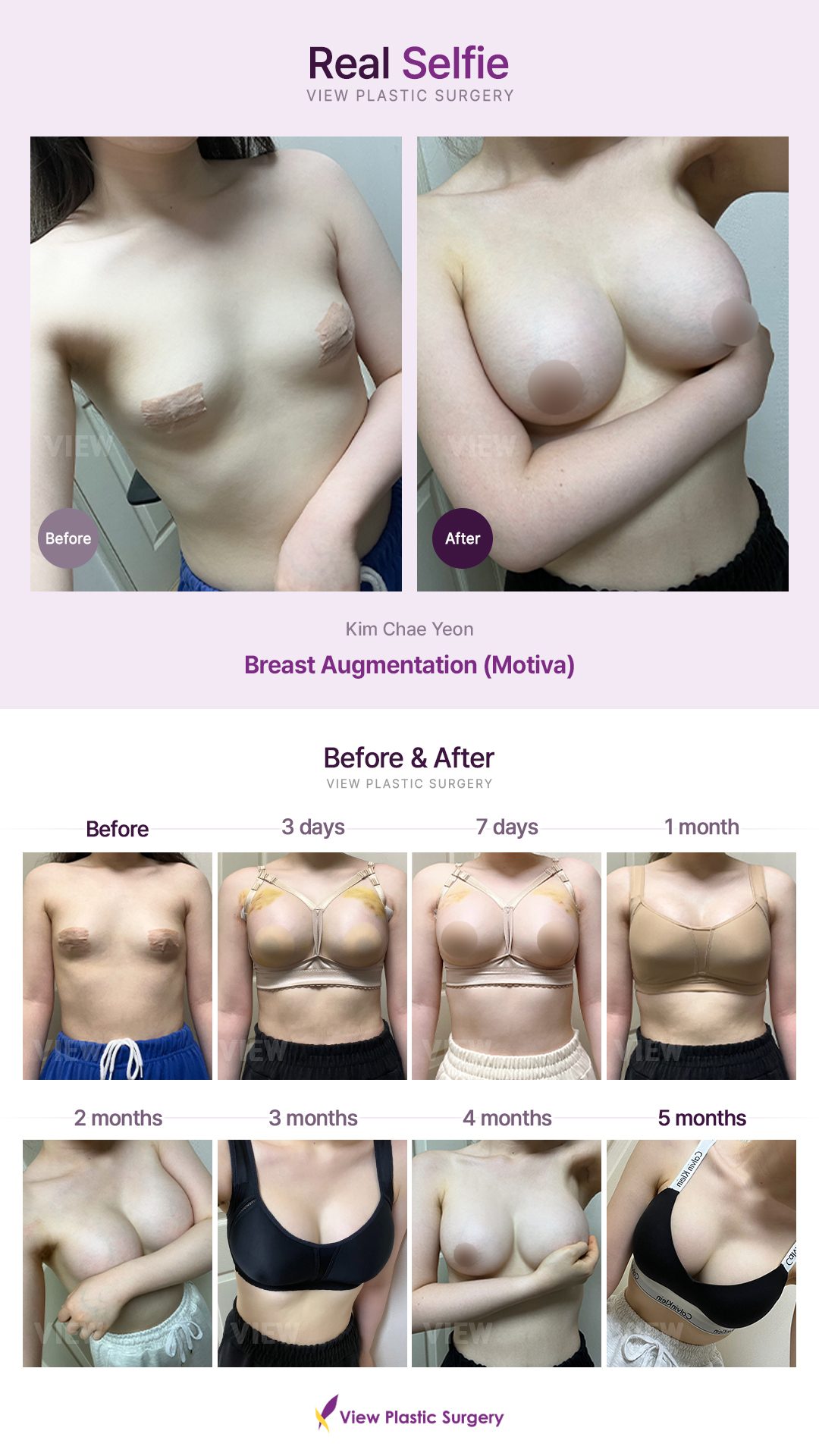 Breast Augmentation (Motiva)