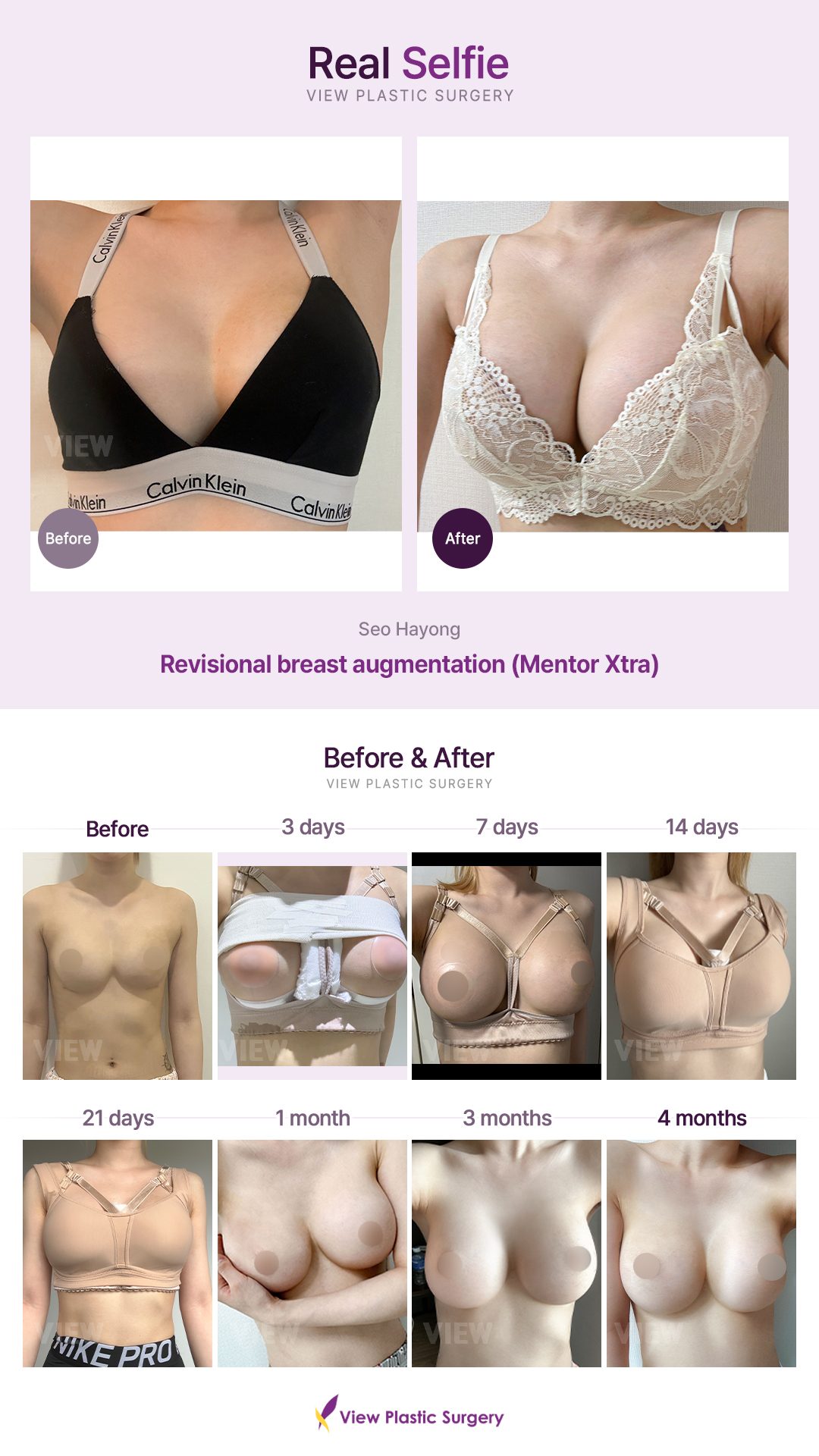 Revisional breast augmentation (Mentor Extra)