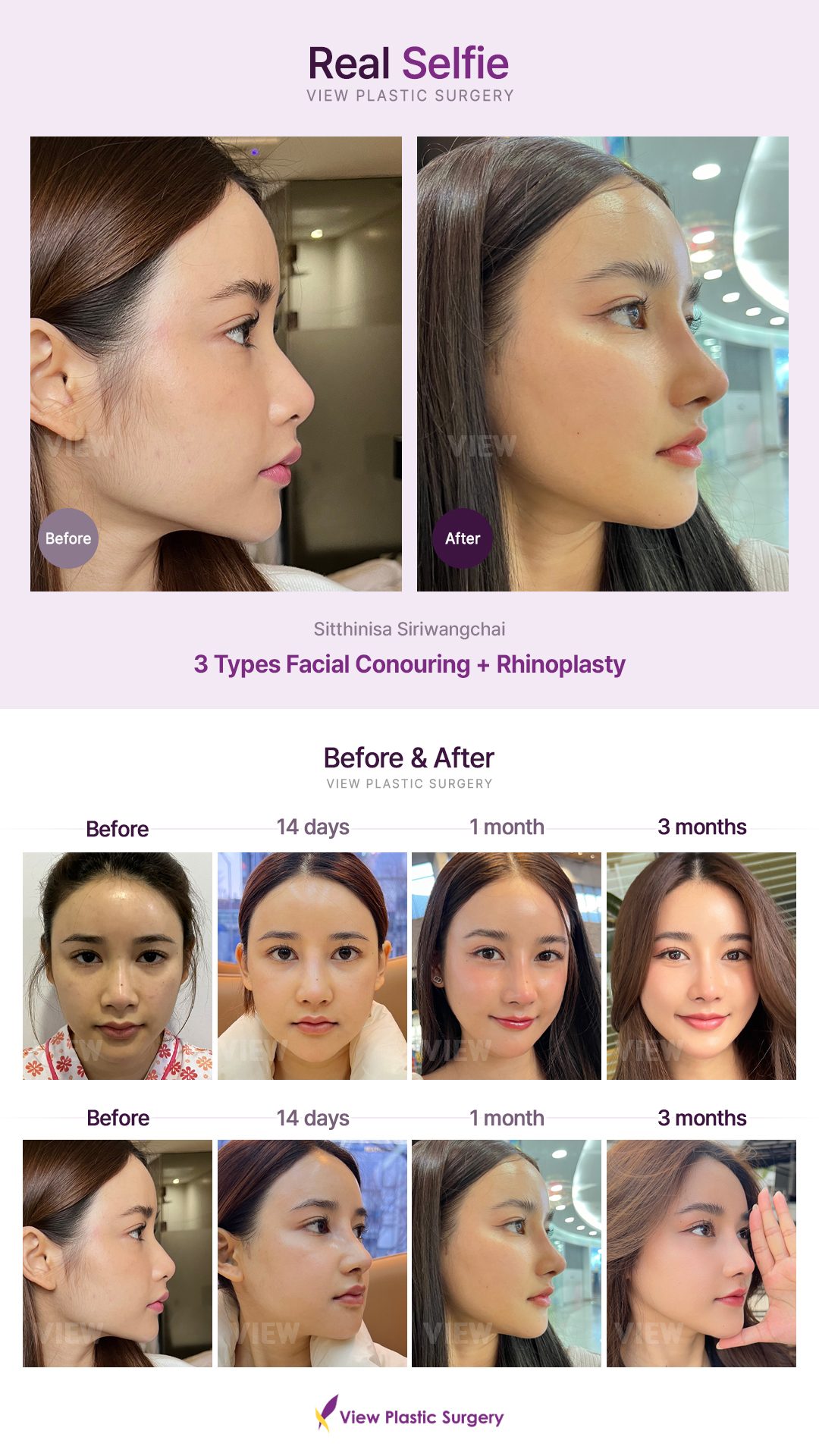 3 Types Facial Contouring + Rhinoplasty
