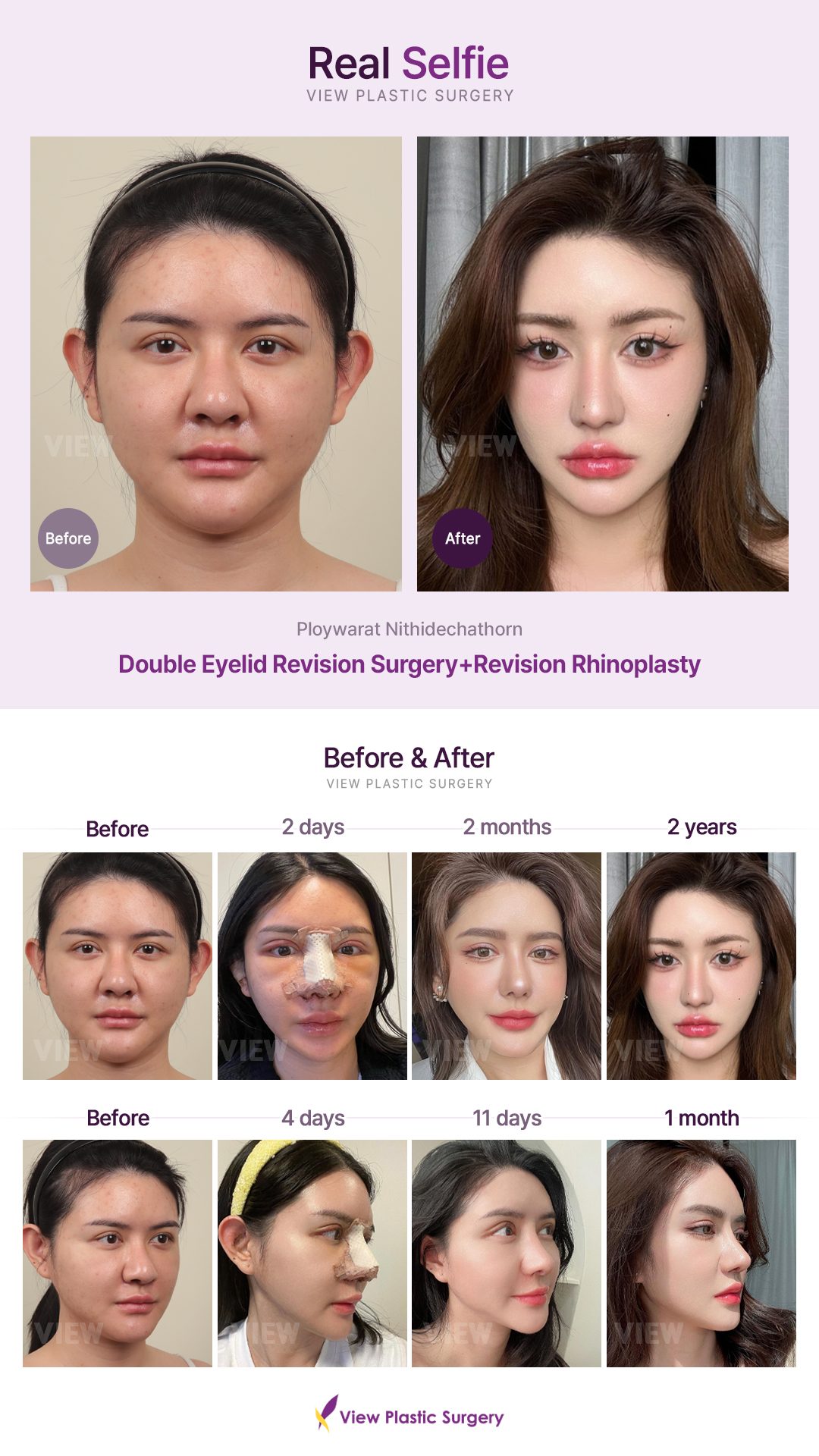 Double Eyelid Revision Surgery+Revision Rhinoplasty