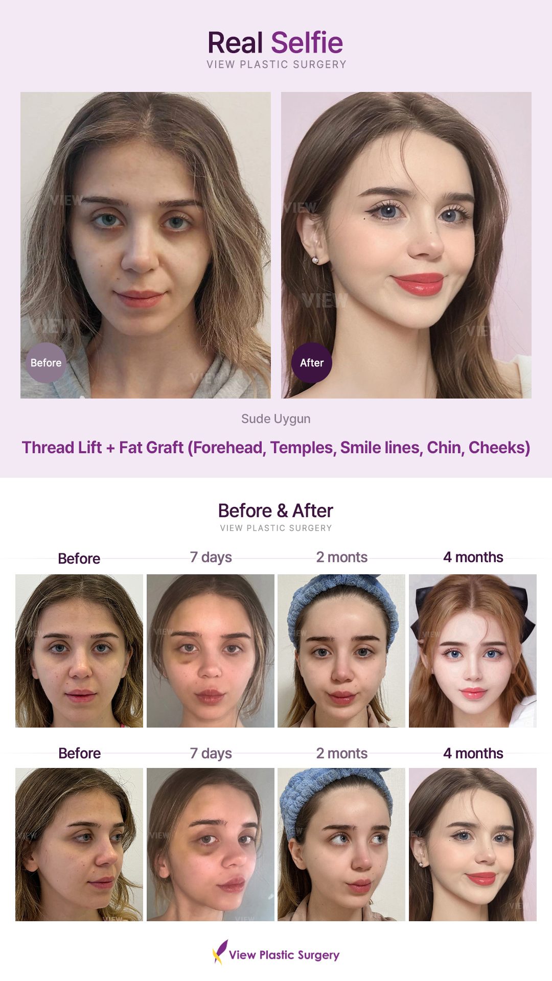 Thread Lift + Fat Graft (Forehead, Temples, Smile lines, Chin, Cheeks)
