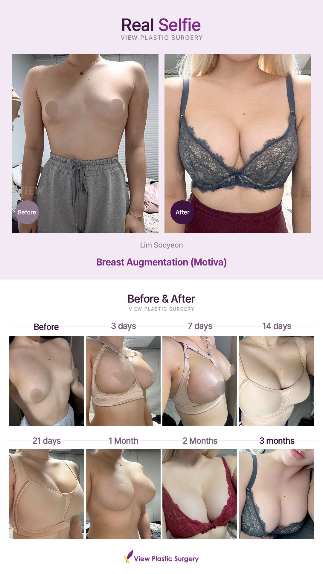 Breast Augmentation (Motiva)