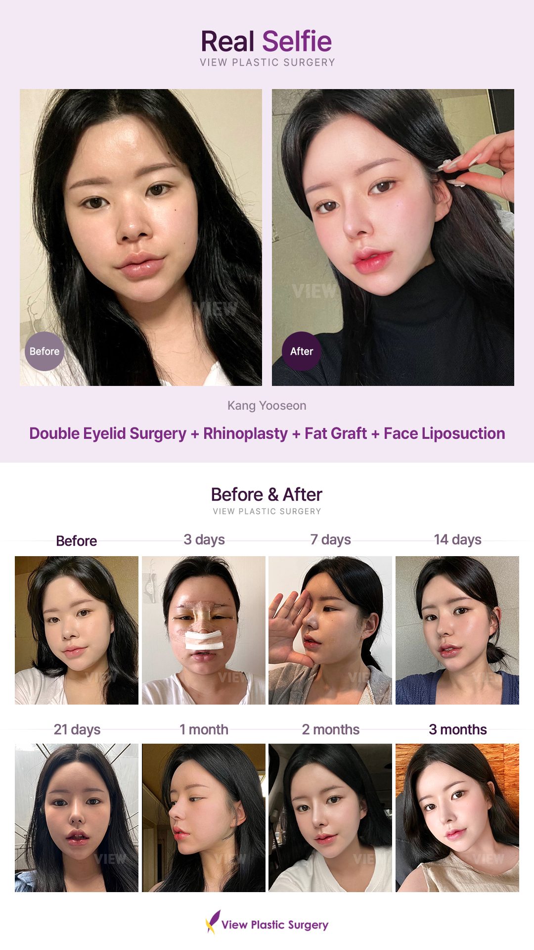 Double Eyelid Surgery, Rhinoplasty, Fat Graft, Face Liposuction