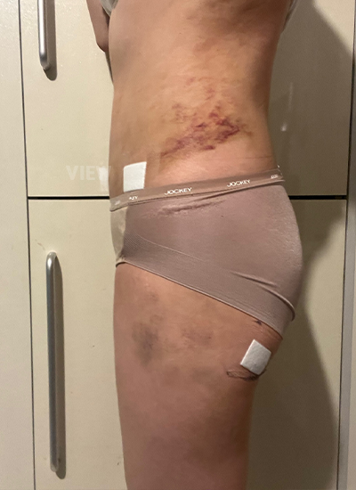 Liposuction 3 Days Post-surgery