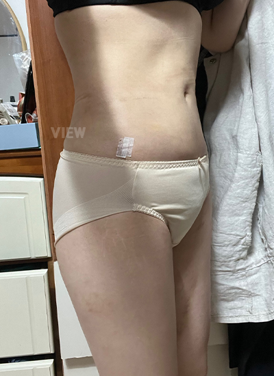 Liposuction 7 Days Post-surgery