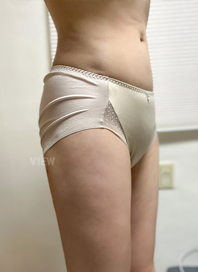 Liposuction 1 Month Post-surgery