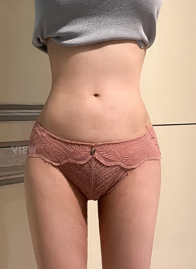Korea Liposuction after 1 month